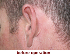 plastic-surgery-prominent-ear 